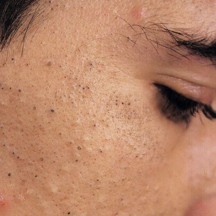 Les dermatoses professionnelles