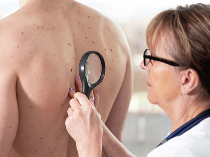 Riconoscere e curare un tumore della pelle
