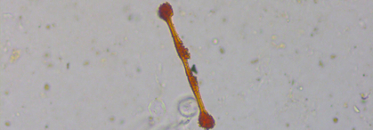 Nouveautés relatives au suivi après exposition à l’amiante et au programme de dépistage par scanner de la Suva
