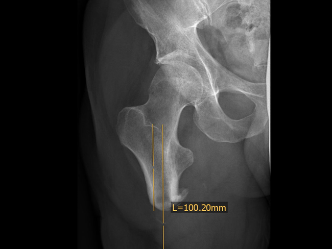 knochlange_femurs_oberschenkelamputationen.png