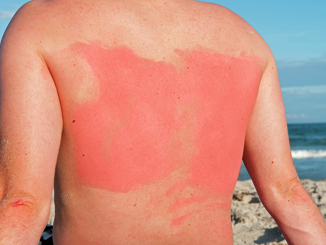 Auf dem Rücken einer Person, die an einem felsigem Strand auf das Meer blickt, sieht man einen starken Sonnenbrand.