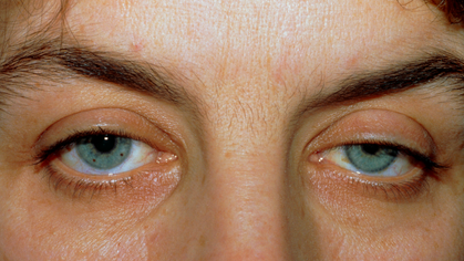 Lésions vasculaires cérébrales dues à un accident