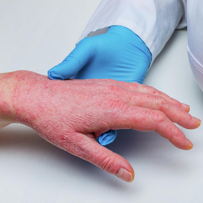 Comment enlever de la résine époxy sur les mains