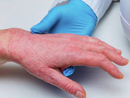 Sviluppo di danni alla pelle, eczemi e allergie