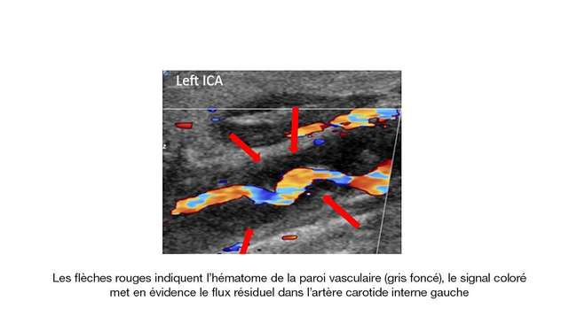 Neurodplexsonographie Bild 4 FR.tif