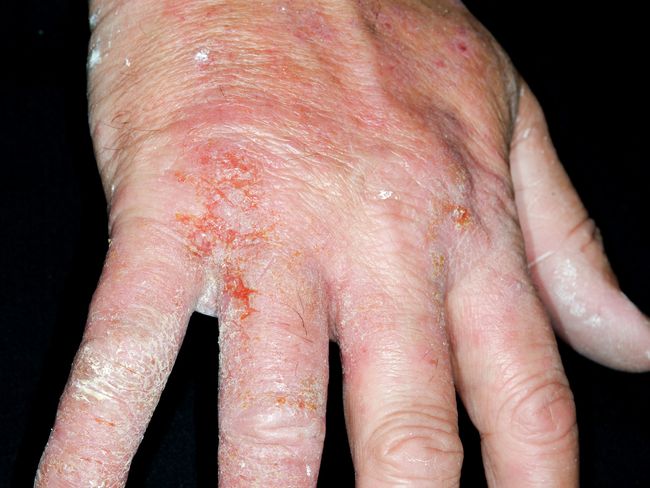 Subakutes superinfiziertes Handekzem 