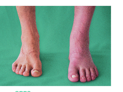 CRPS Complex Regional Pain Syndrome Publikation