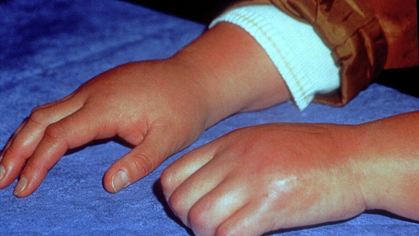 Cochrane Corner – CRPS: lots of therapeutic approaches, little evidence