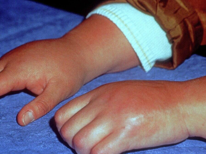 Cochrane Corner – CRPS: lots of therapeutic approaches, little evidence