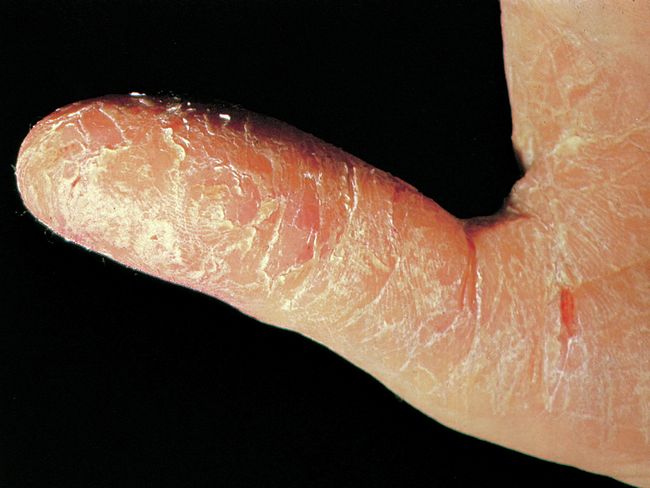 Pollice arrossato e desquamato, un tipico segno di eczema irritativo.