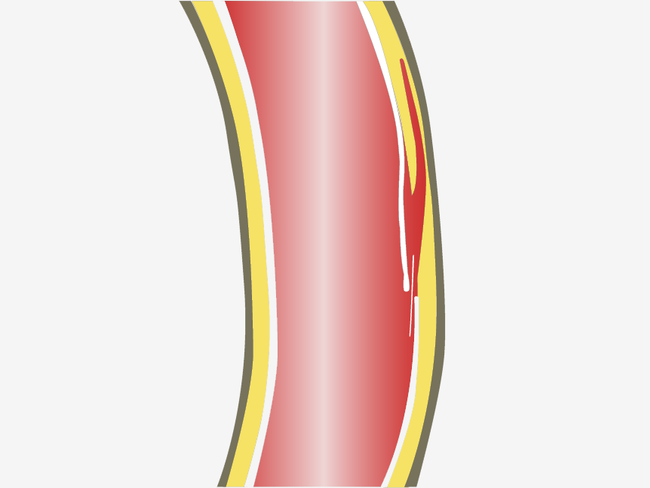 PathomechanismusnEinriss der Gefässwand (Tunica media).png