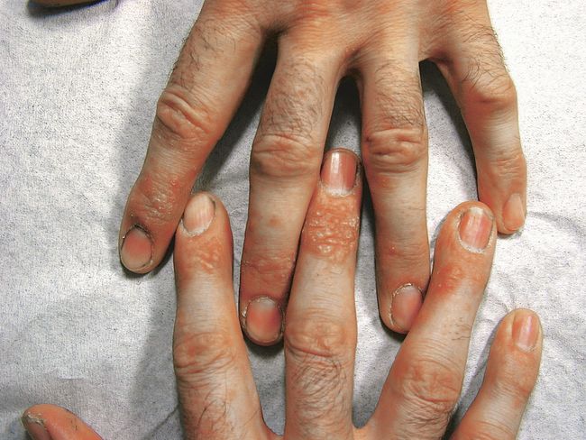 De petites cloques rougeâtres apparaissent sur les doigts de deux mains contiguës.
