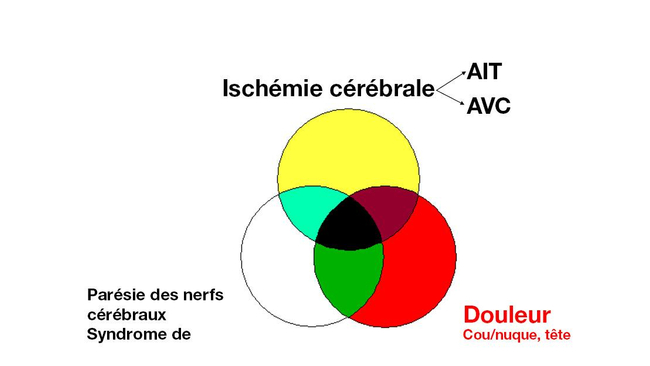 Klinik der Dissektion der A. carotis interna oder A. vertebralis Bild 1 FR.tif