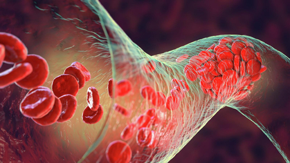 Patient Blood Management: notwendiger Behandlungsstandard – weltweit 