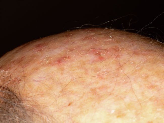 Aktinische-Keratose--Praecancerose--Hautkrebsvorstufe- -actinic-keratosis_00002.jpg