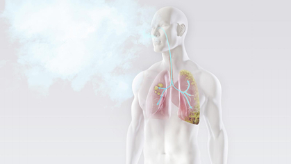 Amianto, la fibra killer