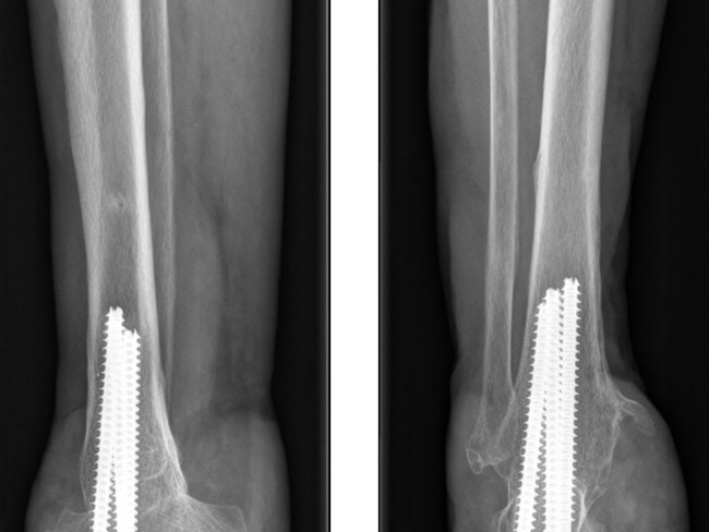 tibio-talo-calcaaneare arthrodese.png