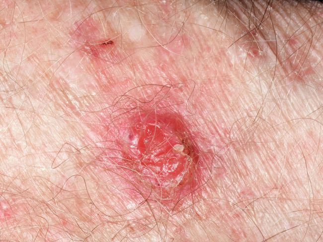 Plattenepithelkarzinom (der Haut)