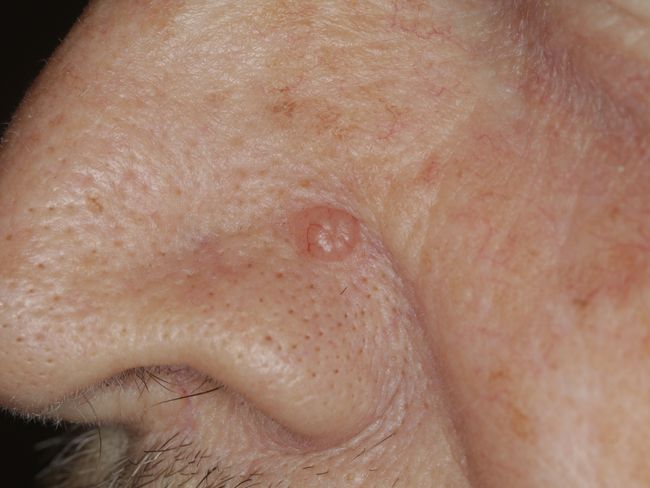 Basalzellcarcinom--Basaliom--basal-cell-carcinoma--bcc-weisser-Hautkrebs--skin-cancer_00001.jpg