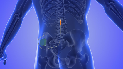 Cochrane Corner: spinal cord stimulation in patients to treat chronic back pain