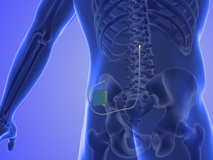 Cochrane Corner: spinal cord stimulation in patients to treat chronic back pain