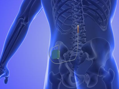 Cochrane Corner: Spinal Cord Stimulation bei chronischen Rückenschmerzen