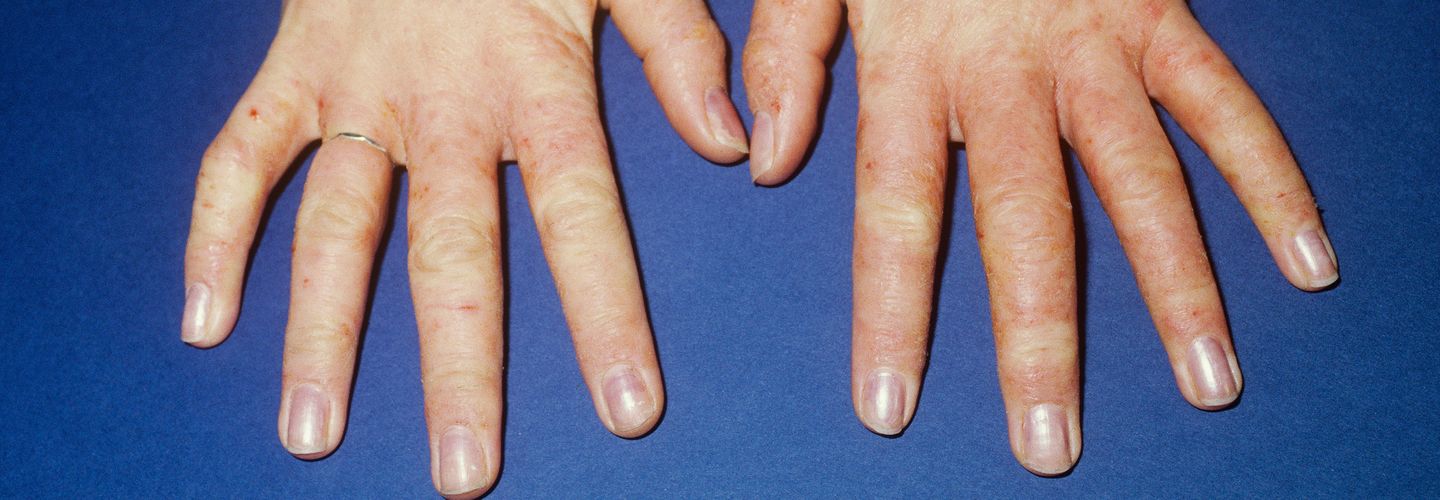 Irritativ-toxisches Handekzem