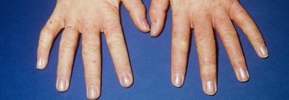 Malattie cutanee professionali