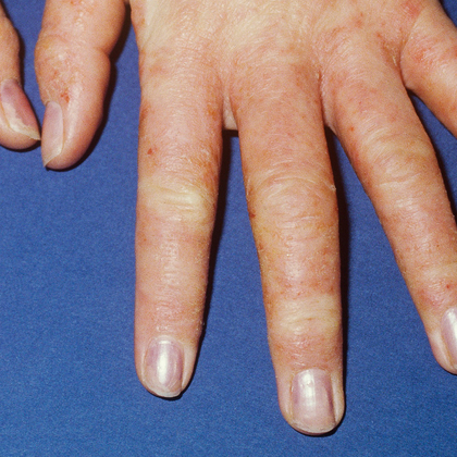 Les dermatoses professionnelles