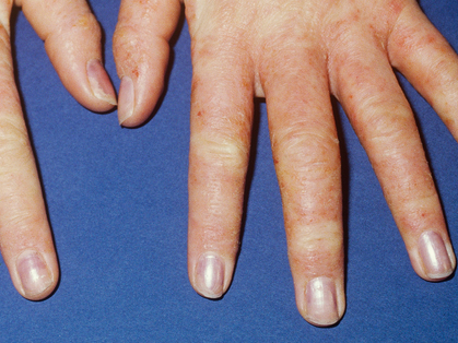 Les dermatoses professionnelles