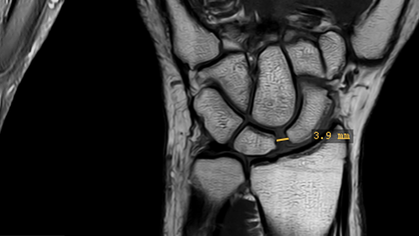 Scapholunäre Bandruptur an der Hand und ihre Folgen