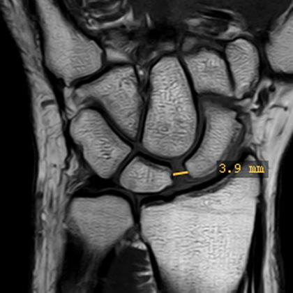 Rupture du ligament scapho-lunaire (SL) du poignet et ses conséquences