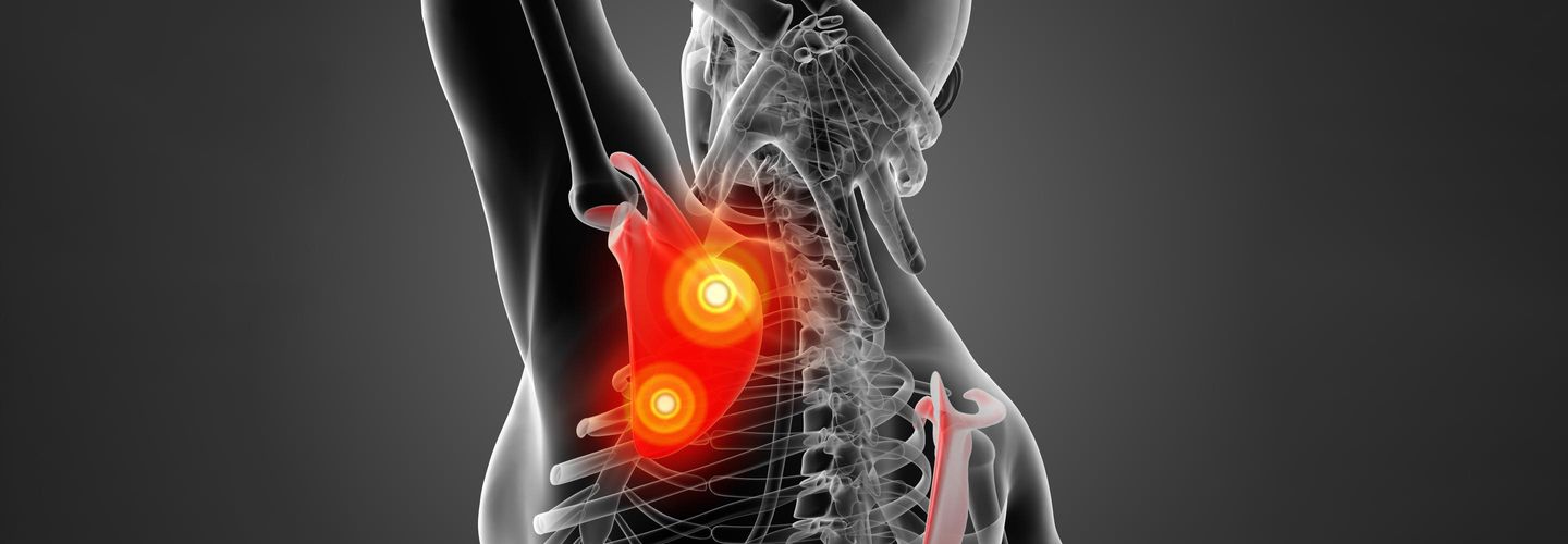 Snapping Scapula - Schulter