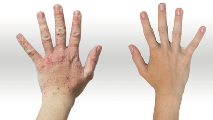 Hautkrankheiten: Schädigende Einflüsse am Arbeitsplatz