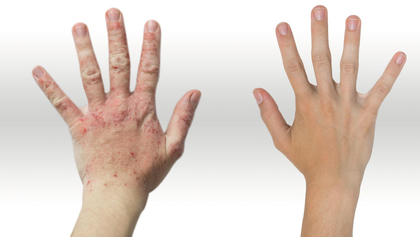 Hautkrankheiten: Schädigende Einflüsse am Arbeitsplatz