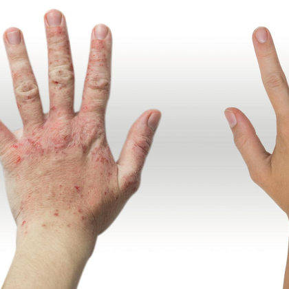 Dermatoses: effets nocifs sur le lieu de travail