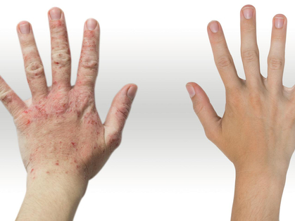 Dermatosi: agenti nocivi sul posto di lavoro