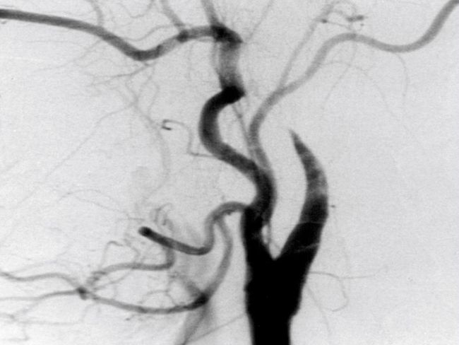 4_3 Angiographie Kontrasmittelabbruch mit typischem Bild des Rattenschwanz.jpg